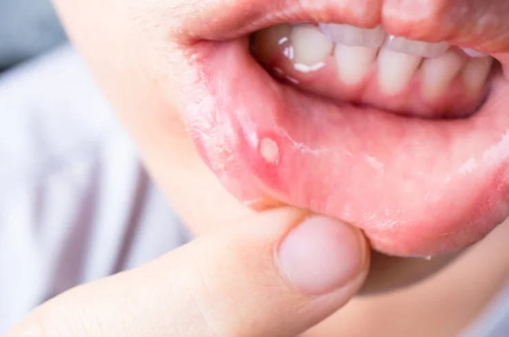 Cysts & Tumors of Mouth & Jaw---02