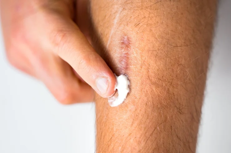 Scar Treatments