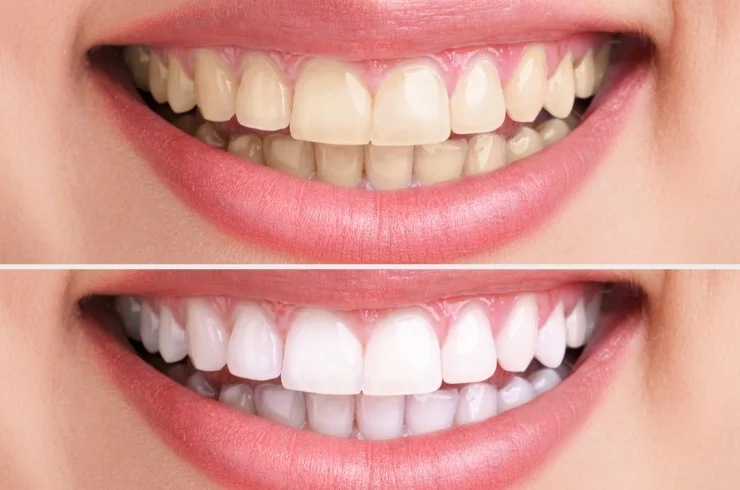 Smile